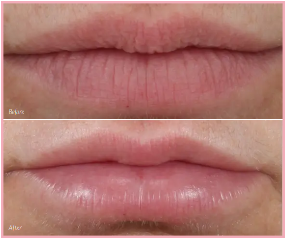 restylane before and after