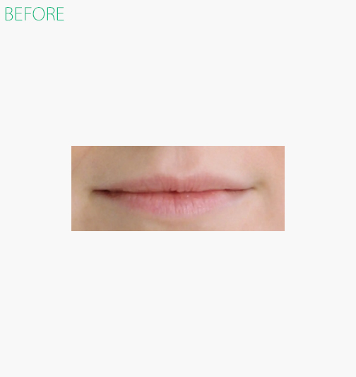 restylane before